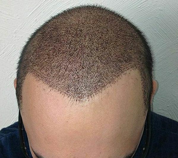 تا چه زمانی باید برای شستشوی موهای کاشته مراقب باشیم؟