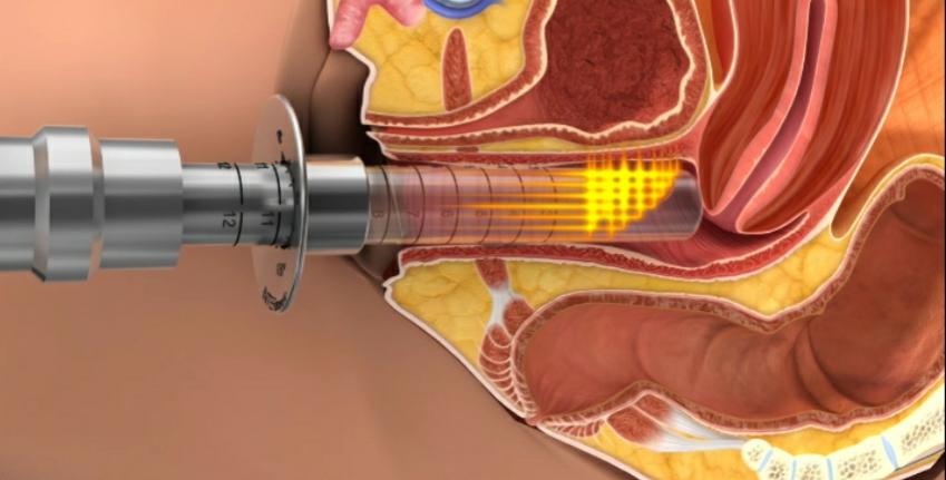 درباره کاربرد درمانی دستگاه مونالیزا بیشتر بدانید!