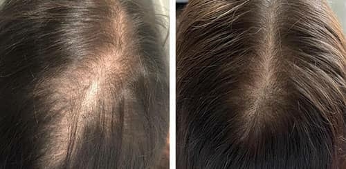 از چه موادی در مزوتراپی مو استفاده می شود!