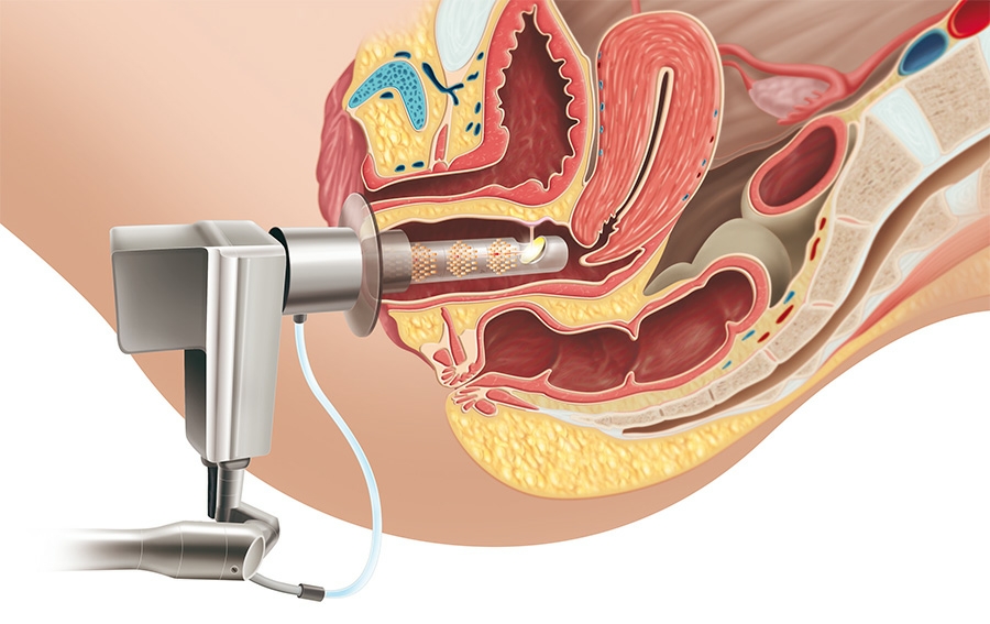 کاربرد دستگاه مونالیزا چیست؟