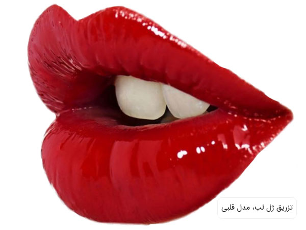 تزریق ژل لب مدل قلوه‌ای