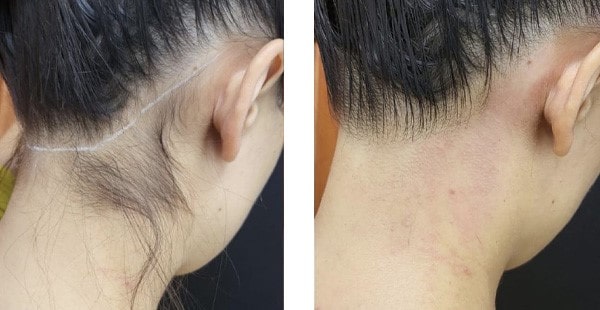 لیزر موهای زائد صورت و گردن