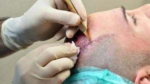 آیا کاشت مو درد دارد؟