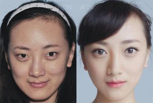 جراحی زیبایی صورت در کره جنوبی