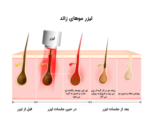 لیزر موهای زائد فواید و مضرات