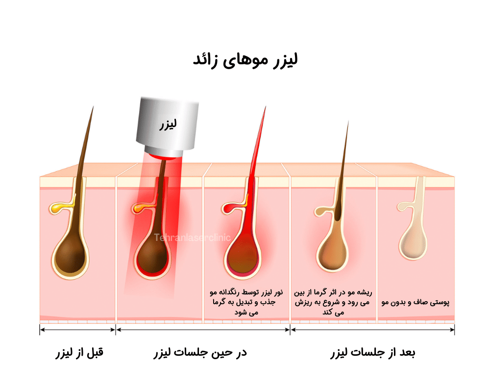 لیزر موهای زائد فواید و مضرات