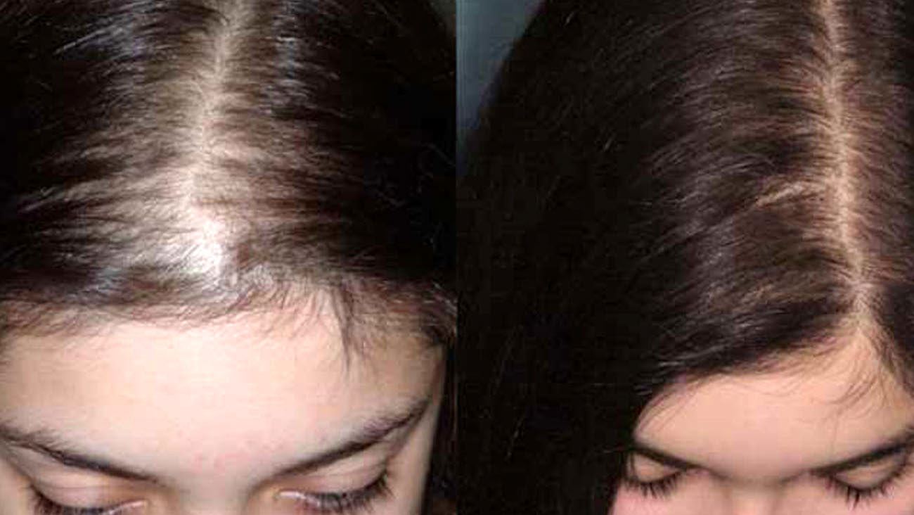 دلایل ریزش مو در زنان