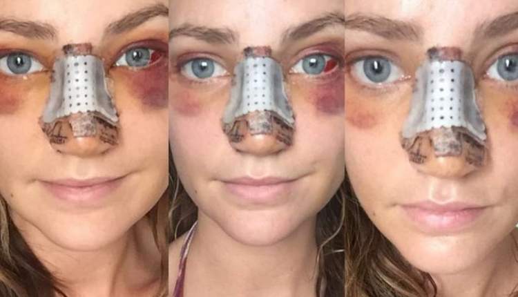 چه کسانی نباید جراحی بینی انجام دهند؟