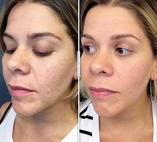 میکرونیدلینگ یک روش جوانسازی خاص