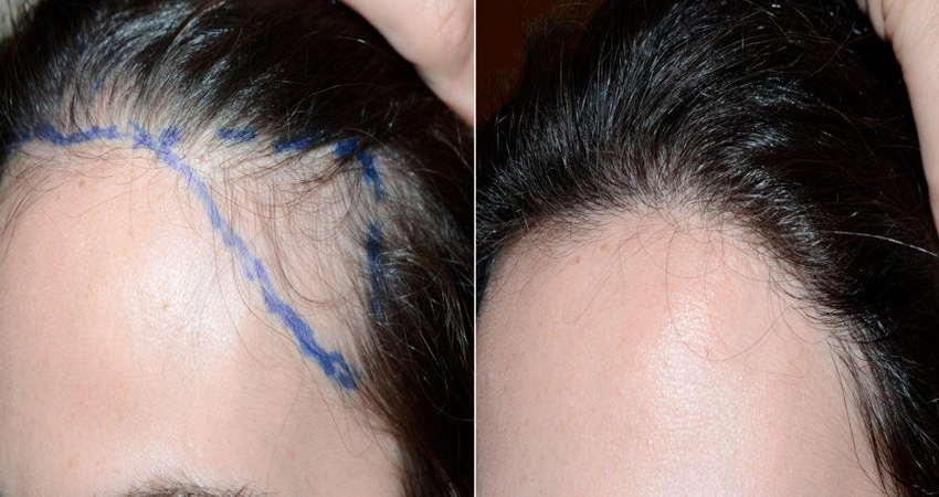 کاشت مو برای زنان به چه صورت انجام می‌شود؟