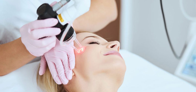 مزایای لیزر صورت آقایان