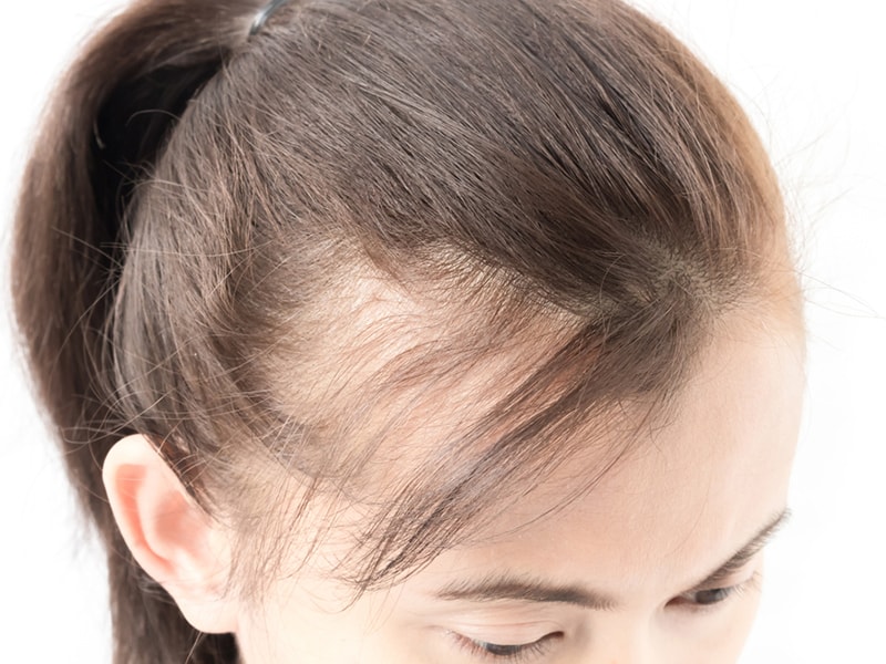  ریزش موی ارثی یا همان آلوپسی آندروژنی به چه علت رخ می‌دهد؟