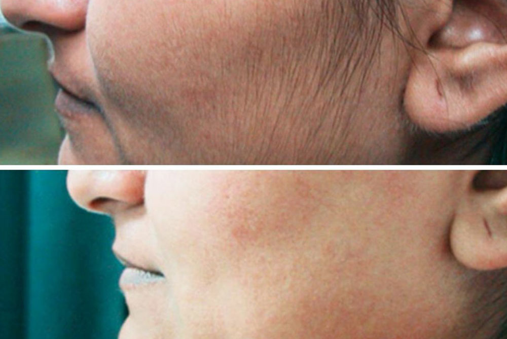 لیزر موهای زائد پشت گردن برای آقایان هم قابل انجام است؟