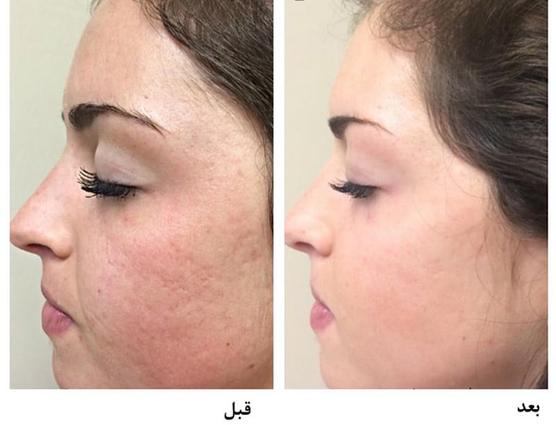 مزایای جوانسازی پوست یا میکرونیدلینگ