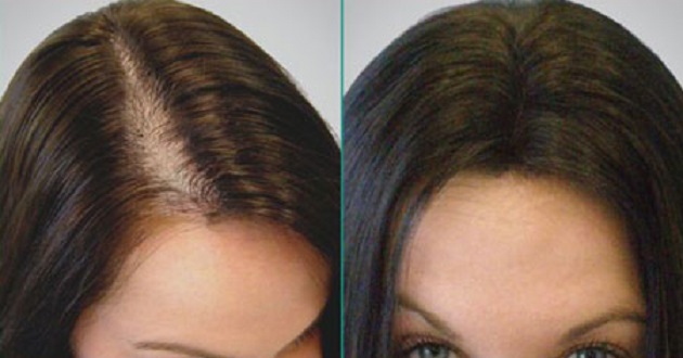 ریزش مو وابسته به زخم ایجاد شده در سر: