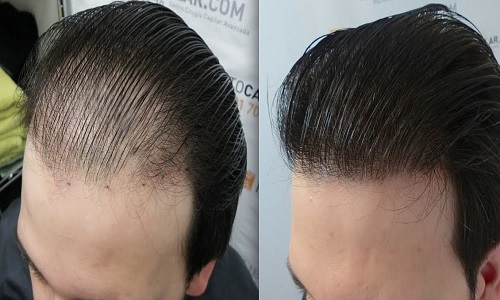 سن مناسب کاشت مو در مردان