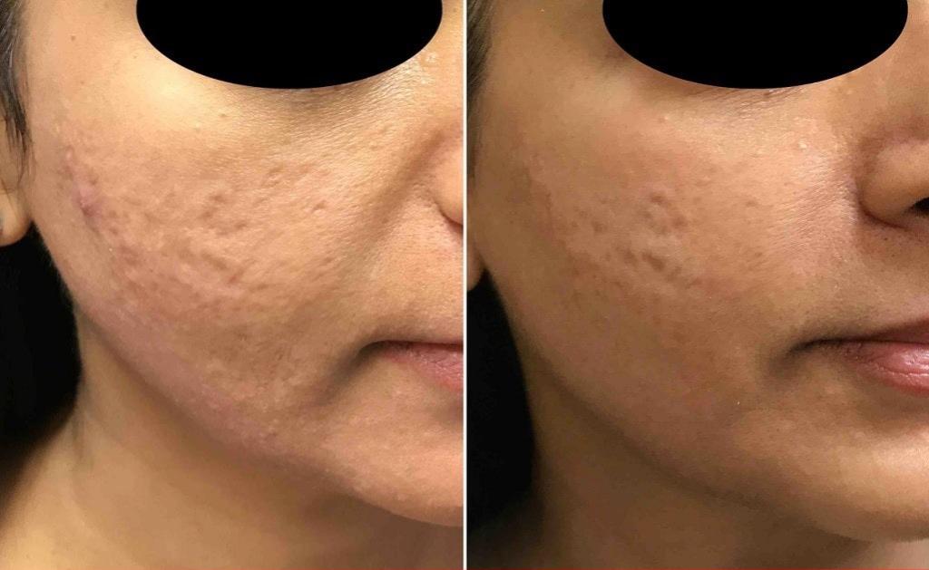 بهترین مرکز جهت اجرای تکنسین میکرونیدلینگ