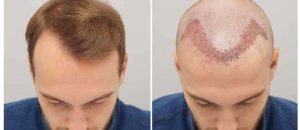 کاشت مو به روش میکروگرافت