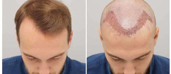 کاشت مو به روش میکروگرافت