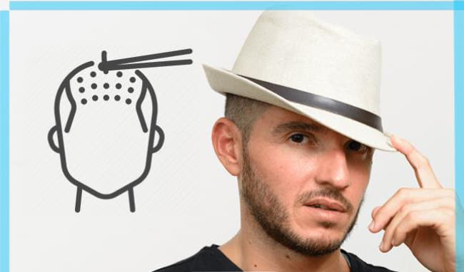 استفاده کلاه بعد از کاشت مو ضرر دارد؟