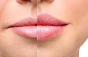 تزریق ژل لب مدل هالیوودی