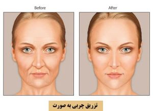 زاویه سازی صورت ژل بهتر است یا چربی؟