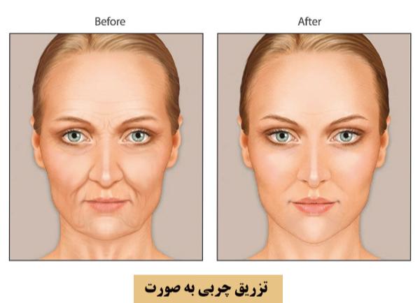 زاویه سازی صورت ژل بهتر است یا چربی؟