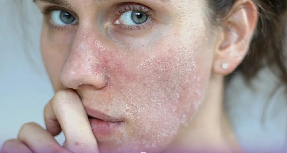 خطرات و عوارض میکرونیلدینگ