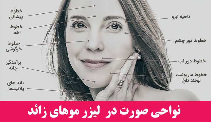 لیزر موهای زائد صورت زنان