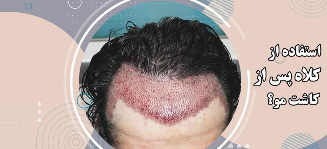 مناسب ترین کلاه برای استفاده بعد از کاشت مو مناسب ترین کلاه برای استفاده بعد از کاشت مو