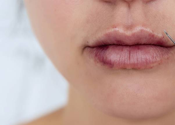 آیا تزریق ژل به لب باعث کبودی آن می شود؟