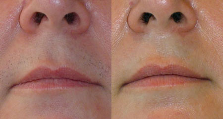 آیا لیزر موهای زائد زنان شیوه‌ای دائمی می‌باشد؟