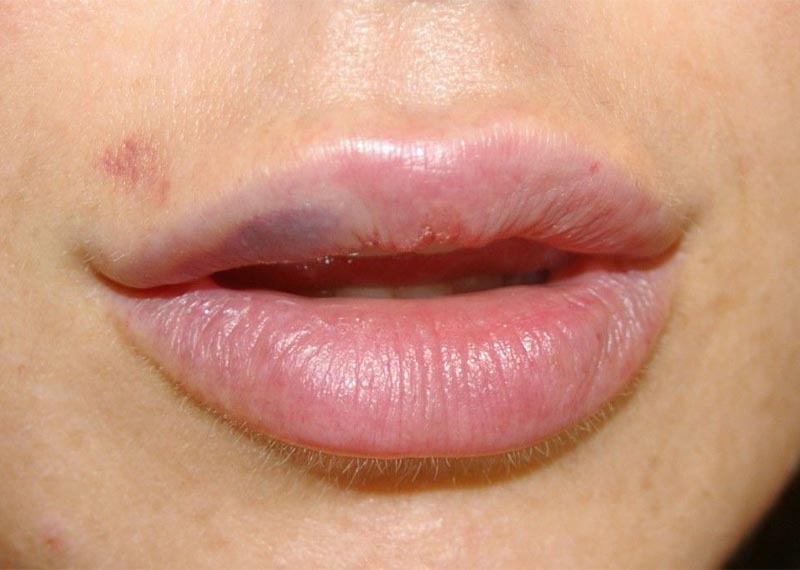علل کبودی لب پس از تزریق ژل