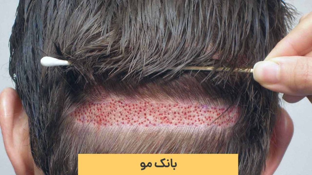 چگونه می توان به سلامتی بانک مو و گرافت مو کمک کرد؟ چگونه می توان به سلامتی بانک مو و گرافت مو کمک کرد؟