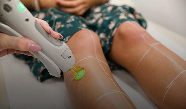 تعداد شارژ لیزر های مو های زائد تعداد شارژ لیزر های مو های زائد