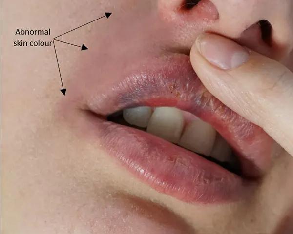 راه هایی برای جلوگیری از کبودی لب بعد از تزریق ژل