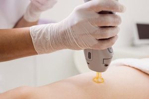 تعداد شات برای لیزر کل بدن چقدر است؟