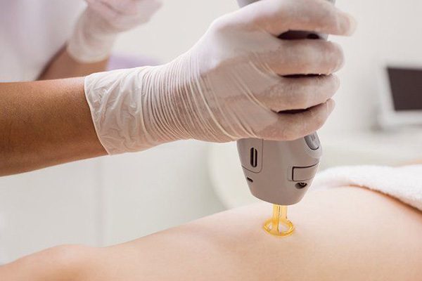 تعداد شات برای لیزر کل بدن چقدر است؟