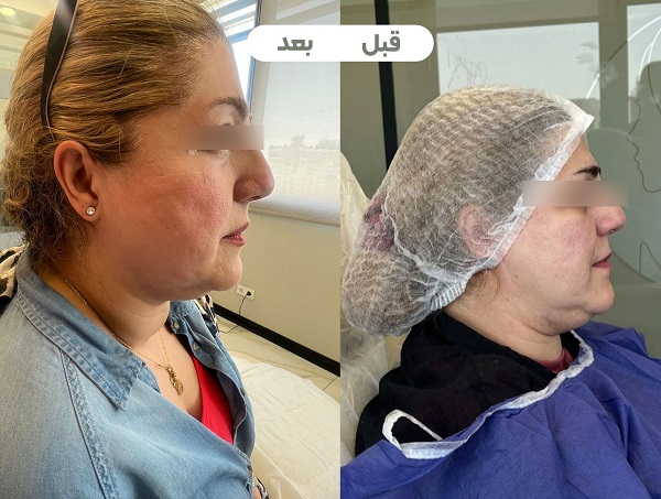 اندولیفت بهتر است یا هایفو؟