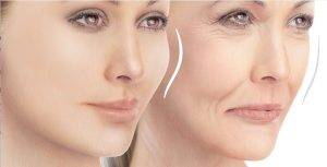 تزریق ژل+هزینه و معایب و مزایا