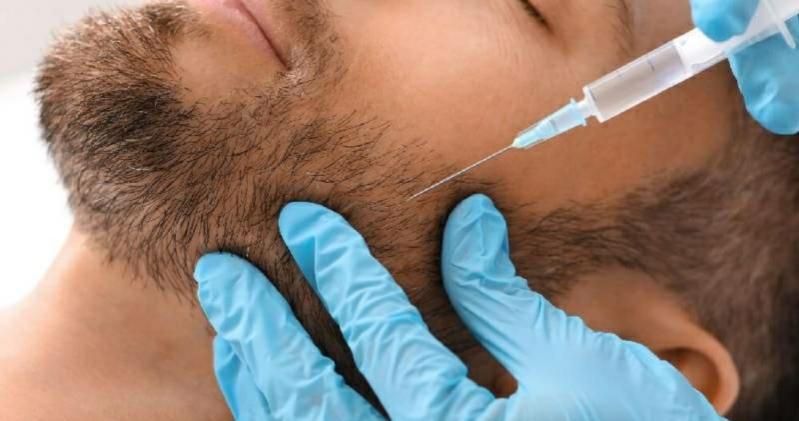 مزوتراپی ریش