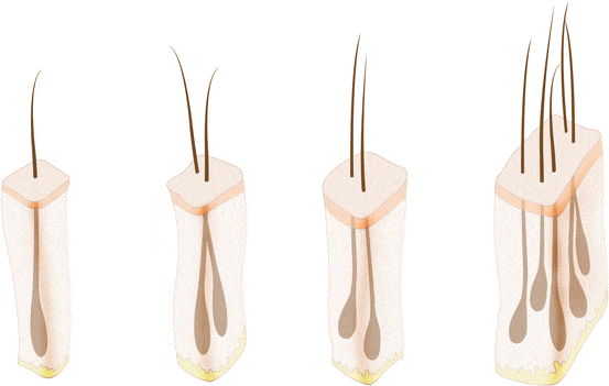 گرافت مو و بانک مو چیست؟