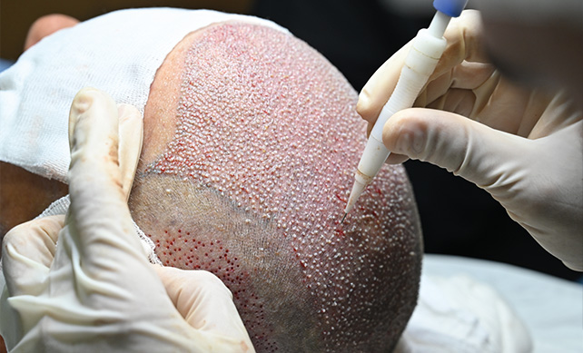 مزایای کاشت مو با جدیدترین متدهای روز