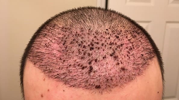 عوارض احتمالی رنگ کردن پس از کاشت مو