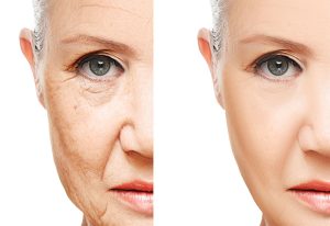  تفاوت عمده آر اف فرکشنال و هایفوتراپی