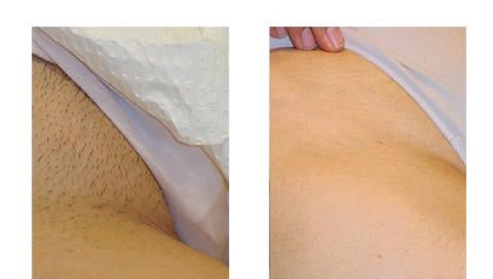 آیا در لیزر بیکینی مقعد هم مورد لیزر قرار می ‌گیرد؟