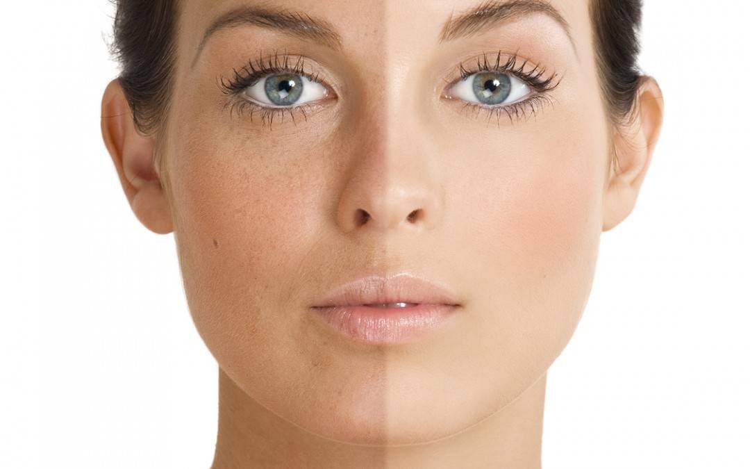 آیا لیزر باعث تیره شدن پوست می شود؟