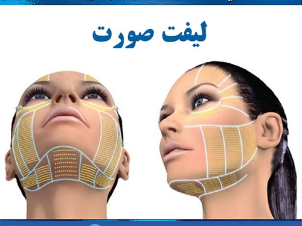 مراقبت‌های بعد از لیفت با نخ