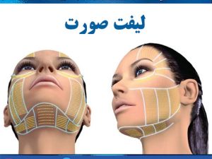 مراقبتهای بعد از لیفت با نخ