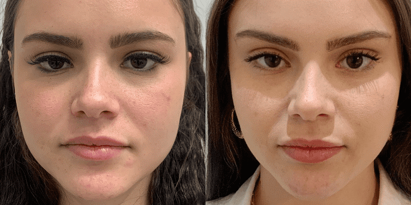 دوران نقاهت لیفت صورت